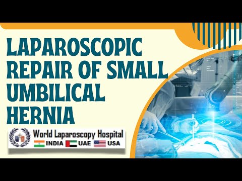 Laparoscopic Repair of Small Umbilical Hernia using Mishra's Knot and Dual Mesh