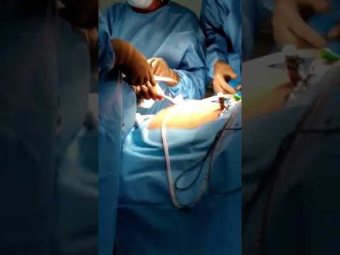 Laproscopy surgery done under general anesthesia #anesthesiology