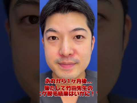 竹田医師ヒゲ脱毛のその後は？！ #湘南美容クリニック #湘南美容クリニック札幌院 #ヒゲ脱毛　#美肌 #医療脱毛