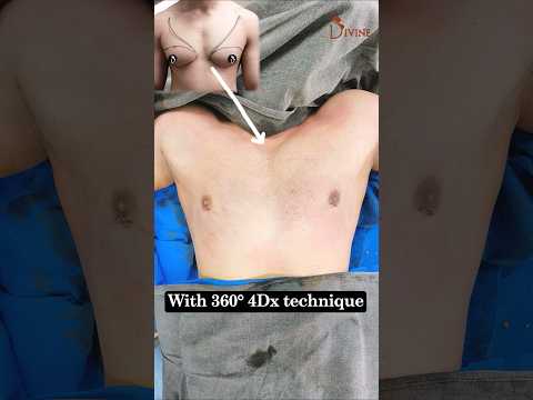 Gynecomastia After Surgery Result by Best Surgeon in Delhi #shortsviral