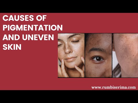 Causes of Pigmentation and Uneven Skin