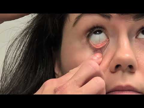 Fixing a displaced lens: what to do when it slides out of place