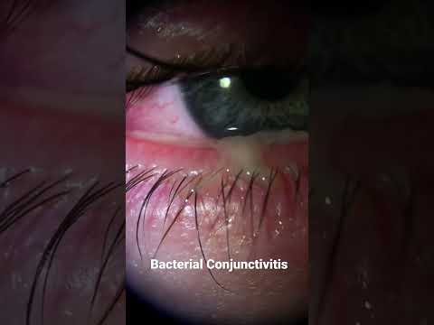 Bacterial Conjunctivitis