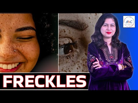 Freckles: What They Are & How to Treat Them | Dr. Cheena Langer, Jammu’s Trusted Skin Expert