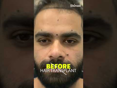 How a hair transplant can change your life | Skinaa Clinic #viral #shortsviral