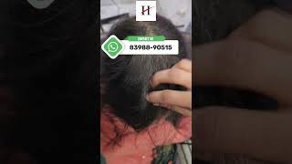 Hairloss? Now Treatment Possible #drchabra #hairfall #hairloss #hairlosstreatment #hairlosssolution