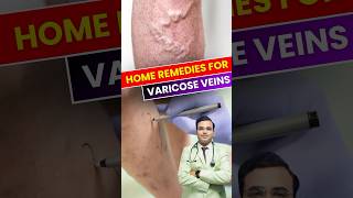 Varicose Veins ठीक करने का घरेलू उपाय #varicoseveins #homeremedies #healthytips