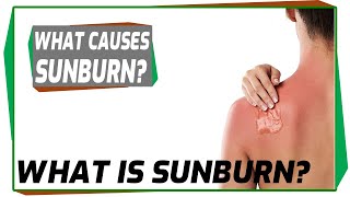 What is Sunburn? Sunburn, Causes, Signs and Symptoms, Diagnosis and Treatment