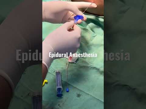 Epidural Anaesthesia - Epidural tuohy Needle & Epidural Catheter..