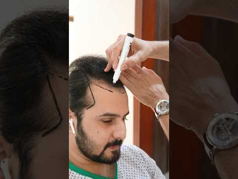 Witness the Art of Hair Restoration ! #drranairfan #hairfall #hairtransplant #fyp #shorts