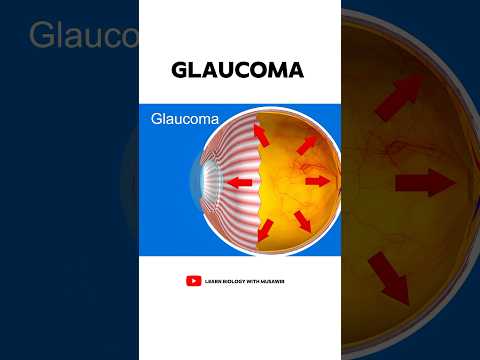 What is Glaucoma 👁️?