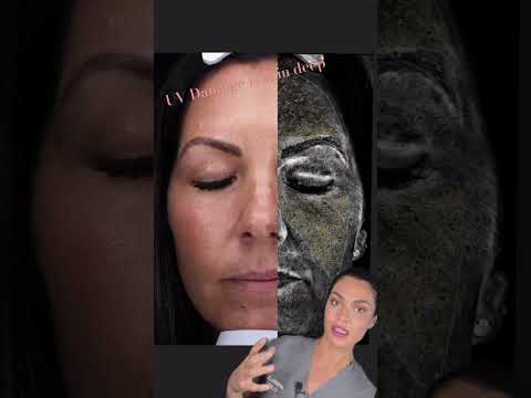 UV damage cannot be seen by naked eye! When sun damage is apparent, there is more damage underneath