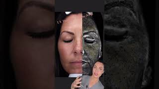 UV damage cannot be seen by naked eye! When sun damage is apparent, there is more damage underneath