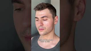 UV damage, dark spots