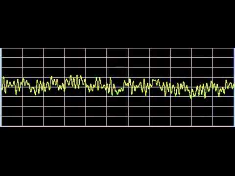 Syringomyelia - Rife Frequencies