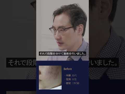 ニキビ跡の症状/診断/過程/ビフォーアフターの比較