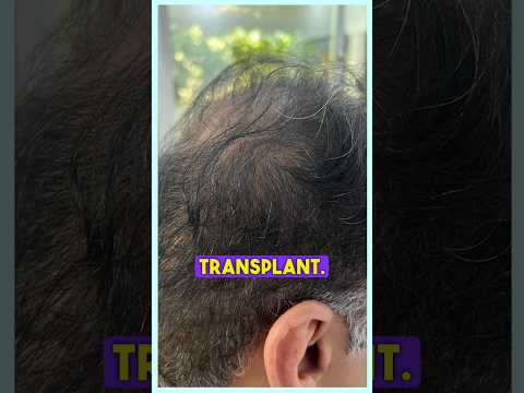 Cheap Hair Transplant ?#drranairfan #hairfall #hairtransplant #hairloss #fyp #shorts