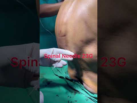 Kyphoscoliosis Patient with Difficult Spinal..              #Spinal needle 23G #CSF