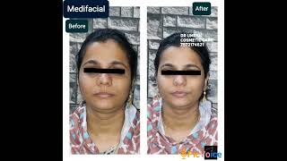 #medifacial #cosmetic #face #detanfacial #skinwhitening #skinlightening #glowingskin #skincare