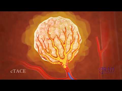 Liver Tumor Embolization & Chemoembolization